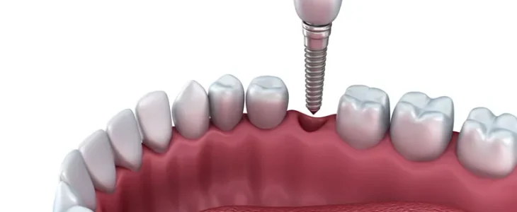 Dental Implants: The Perfect Solution For Missing Teeth