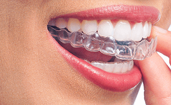 Discover The Best Invisalign Options For Straighter Teeth